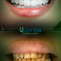 کامپوزیت، لمینت، ایمپلنت اقساط ویژه|خدمات آرایشگری و زیبایی|محلات, |دیوار