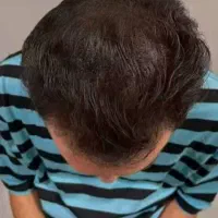 درمان قطعی ریزش مو و رد مجدد مو با پکیج درمانی H3|خدمات آرایشگری و زیبایی|شاهین‌شهر, خانه کارگر|دیوار