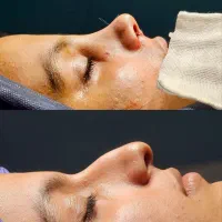 جراحی بینی دکتر اسدالله پور