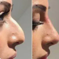 ژل بوتاکس تضمینی