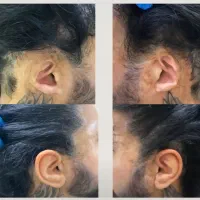 گوش مصنوعی (پروتز گوش)