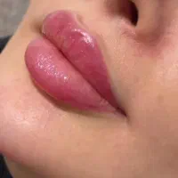 ژل و بوتاکس فیلر مزو ژل مزو تخفیف ویژه فول فیس|خدمات آرایشگری و زیبایی|مشهد, ملک‌آباد|دیوار