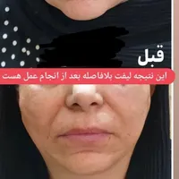 مدل لاغری بدون دستگاه و بدون عوارض‌|استخدام درمانی، زیبایی، بهداشتی|شیراز, قدوسی غربی|دیوار