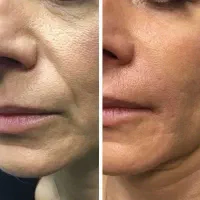 بوتاکس خانگی ـ ضد چین وچروک