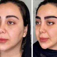 میکروکاشت ابرو و مو فقط 16.800 ظرفیت محدود|خدمات زیبایی و سلامت|قم, زنبیل آباد|دیوار