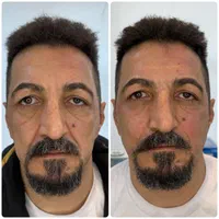 فیلر ‌بوتاکس ژل لب روسی کانتورینگ|خدمات آرایشگری و زیبایی|تهران, جمهوری|دیوار