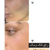 پک صورت گیاهی ضدلک و کک مک|آرایشی، بهداشتی، درمانی|آباده, |دیوار