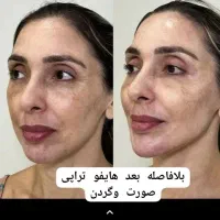 تزریقات ژل و بوتاکس مزو