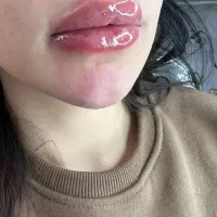 ژل وبوتاکس۴۹۰|خدمات زیبایی و سلامت|کرج, عظیمیه|دیوار
