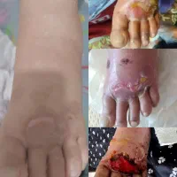 کلینیک تخصصی درمان زخم ( بستر و دیابت) فردوس