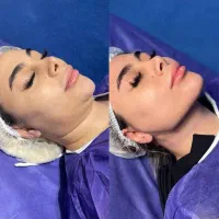 پزشک جراحی بلفا غبغب نخ لیفت کلاژن آنزیم ژل فیلر|خدمات آرایشگری و زیبایی|کرج, گوهردشت|دیوار