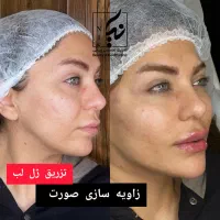 لیپوساکشن غبغب،بوکال فت،فیلرصورت،جوانساز،بوتاکس|خدمات آرایشگری و زیبایی|تهران, شهرک هما|دیوار