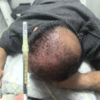 حجامت PRPرفع ریزش مولاغری لیزر موهای زائد کادرپزشک|خدمات زیبایی و سلامت|تبریز, |دیوار