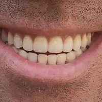 ساخت و تعمیر دندان متحرک با ضمانت