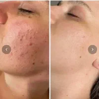 پوست صاف و بدون جوش میخوای