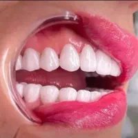 کاشت لبخند / کامپوزیت لمینیت