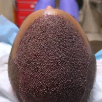 آموزش تخصصی کاشت مو‌ و ابرو‌vip همراه با مدرک