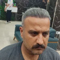 کاشت ابرو مو ریش