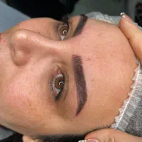 میکروبلیدینگ ابرو، فیبروز ابرو