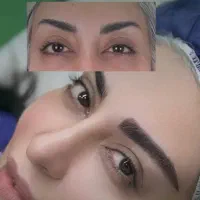 کاشت ابرو و مو