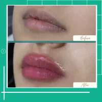 تخفیفات ویژه دکتر ، ژل لب مزو بوتاکس و فیلر