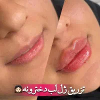 جشنواره ۵۰ درصدی ژل بوتاکس فقط تا سه روز|خدمات آرایشگری و زیبایی|اصفهان, برازنده|دیوار
