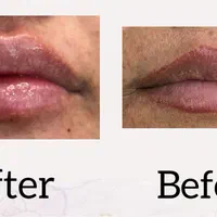تزریق فیلر بوتاکس و لیفت افتادگی صورت و چشم|خدمات آرایشگری و زیبایی|شیراز, عفیف‌آباد|دیوار