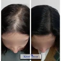 رفع کم پشتی مو با میکرو اسکالپ/ جایگزین کاشت مو|خدمات آرایشگری و زیبایی|مشهد, وکیلآباد|دیوار