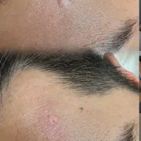 با یک جلسه کک و مکا حذف کن|خدمات آرایشگری و زیبایی|خرم‌آباد, |دیوار