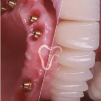 دندانپزشکی ایمپلنت/متخصص فک و صورت/+3000کاشت موفق|خدمات زیبایی و سلامت|تبریز, |دیوار