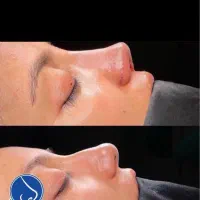 جراحی زیبایی بینی فقط با 30 میلیون تومن