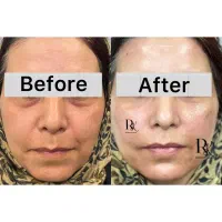 تخفیفات فیلر دهه کرامت