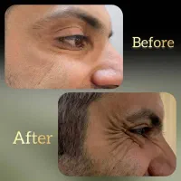 جشنواره بوتاکس پاییزه فقط تا پایان آبان ماه