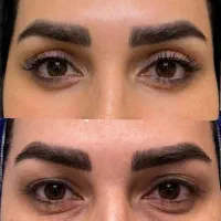جراحی تخصصی افتادگی پلک(بلفاروپلاستی)ابرو و شقیقه