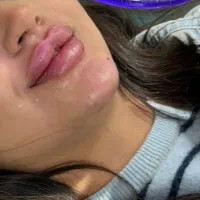 تزریق ژل و بوتاکس مادلینگ بوتاکس رایگان