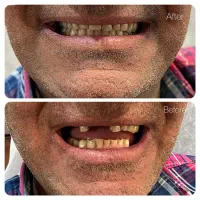 دندانسازی|خدمات آرایشگری و زیبایی|رفسنجان, |دیوار