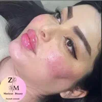 تخفیفات آموزش و تزریق ژل و بوتاکس توسط پزشک