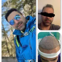 کاشت مو