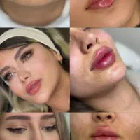 خدمات تخصصی ژل و بوتاکس