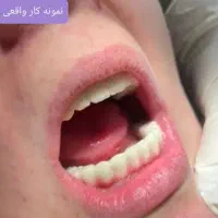 ایمپلنت و اوردنچر تخصصی / پرداخت مرحله ای واقعی|خدمات آرایشگری و زیبایی|اصفهان, بوستان کوهستانی صفه|دیوار