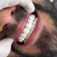 کامپوزیت دندان بابل