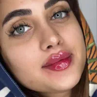 ژل وبوتاکس فقط۳۵۰ژل لب‌،چانه، گونه ،زاویه،خط لبخند