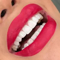 ایمپلنت کامپوزیت ارتودنسی روکش لمینت|خدمات آرایشگری و زیبایی|ایلخچی, |دیوار