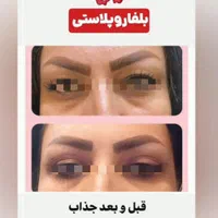 اف ویژه عمل بلفاروپلاستی