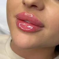 آنزیم ترکیبی بینی گوشتی،لیفت بینی،ژل لب،مزوتراپی|خدمات آرایشگری و زیبایی|تهران, سعادت‌آباد|دیوار
