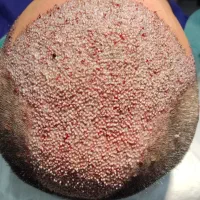 کاشت موی طبیعی