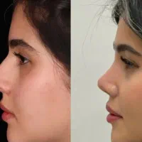 عمل بینی|خدمات آرایشگری و زیبایی|اهواز, نادری|دیوار