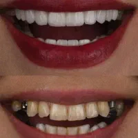 دندانپزشکی و شرایط اقساطی بدون بهره ایمپلنت|خدمات آرایشگری و زیبایی|تبریز, |دیوار