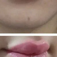 خدمات ژل وبوتاکس