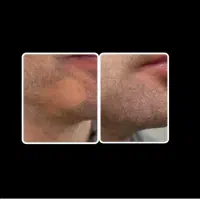 درمان قطعی وتضمینی ریزش سکه ای بدون بازگشت